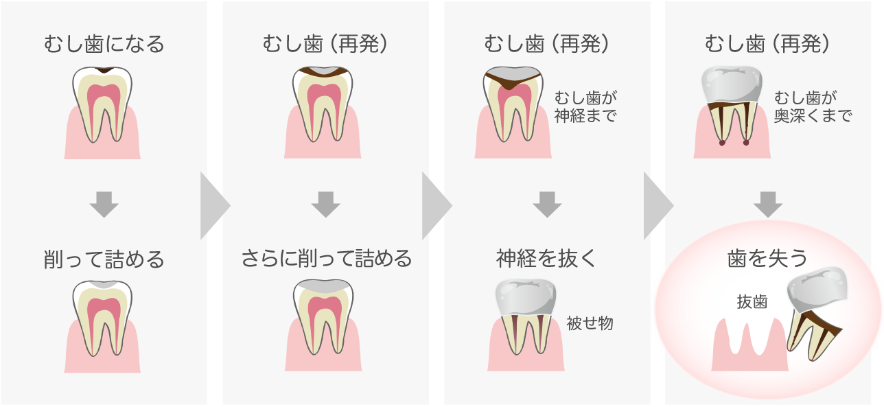 図：歯を失うサイクル