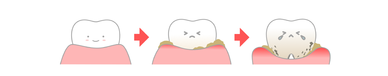 歯周病の進行