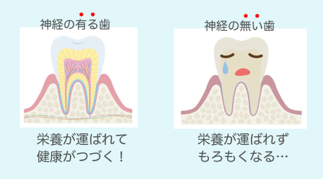 歯の神経を抜いても大丈夫？
